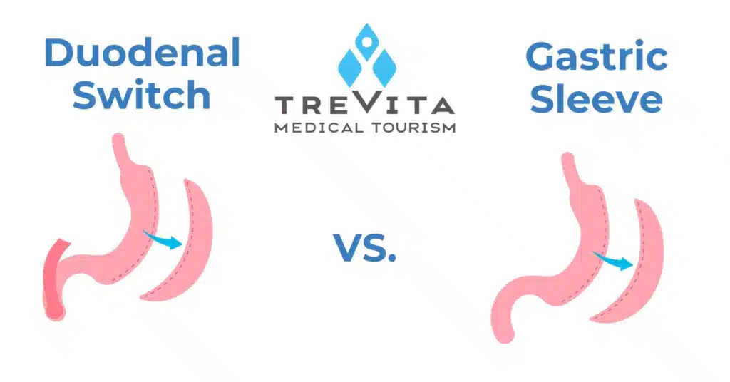 Duodenal Switch vs. Gastric Sleeve