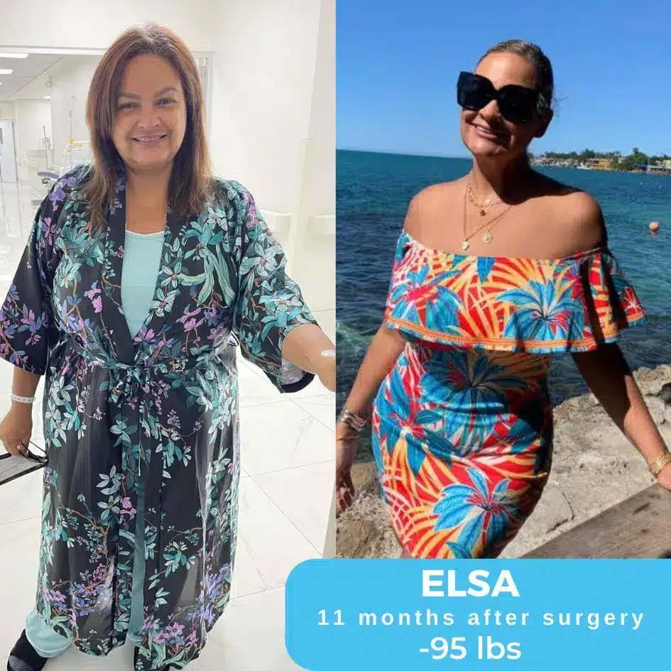 Side-by-side images of Elsa before and after her bariatric surgery, showcasing her significant weight loss and transformation.