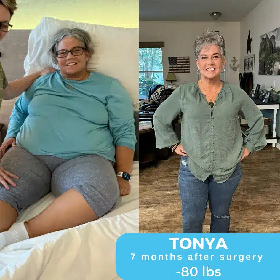 Side-by-side images of Tonya before and after her bariatric surgery, highlighting her impressive weight loss journey.