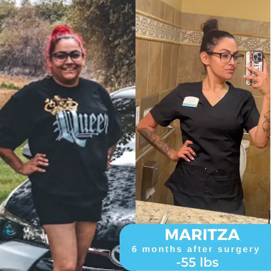 Maritza Before And After Bariatric Surgery